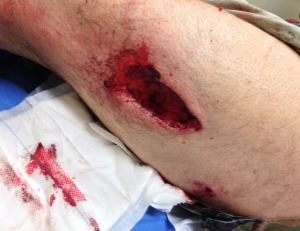 Neames leg